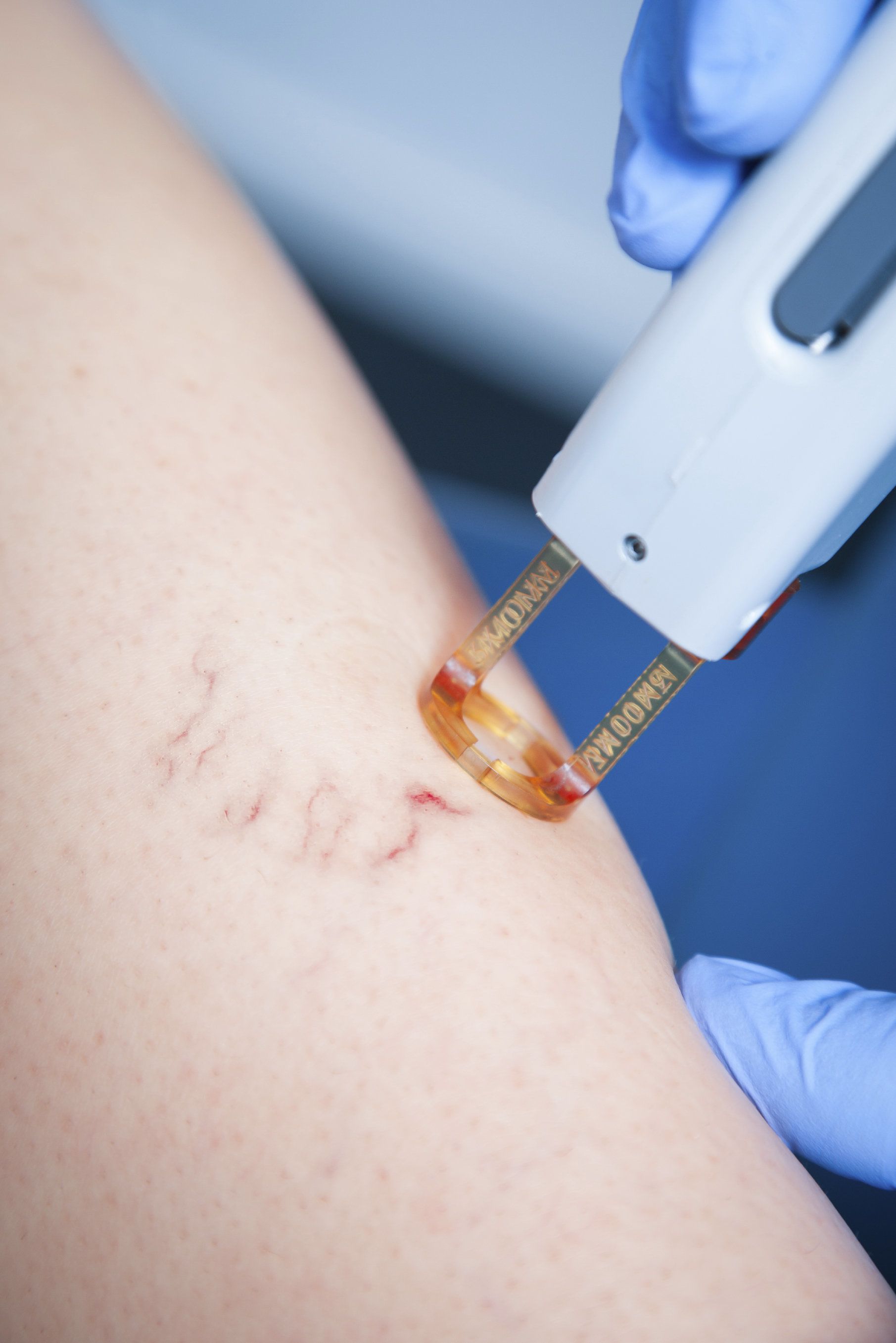 Image of spider vein treatment