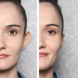 Before and after images of an otoplasty patient.