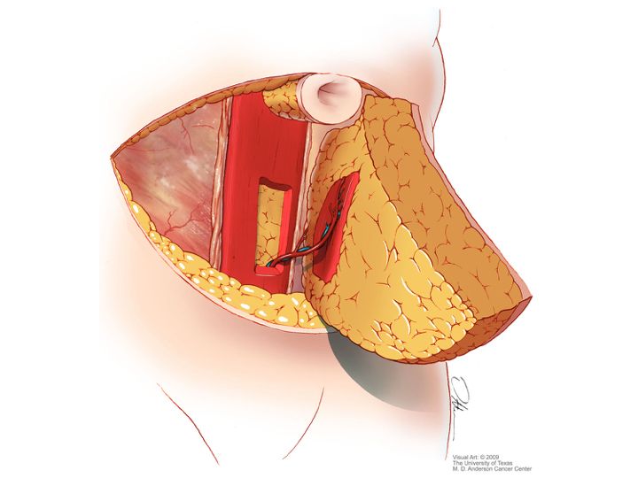 tissue transfer