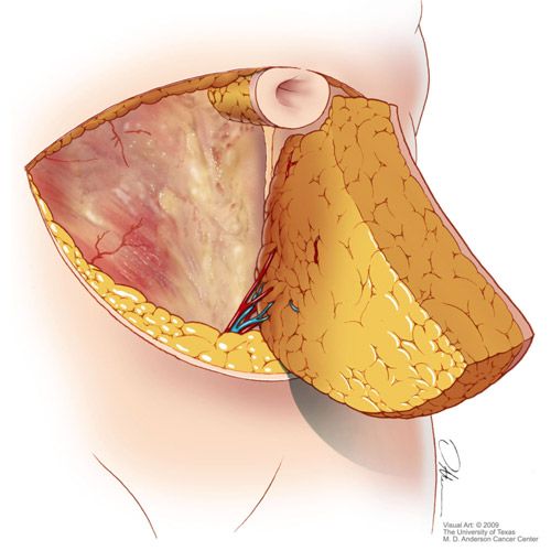 tissue transfer